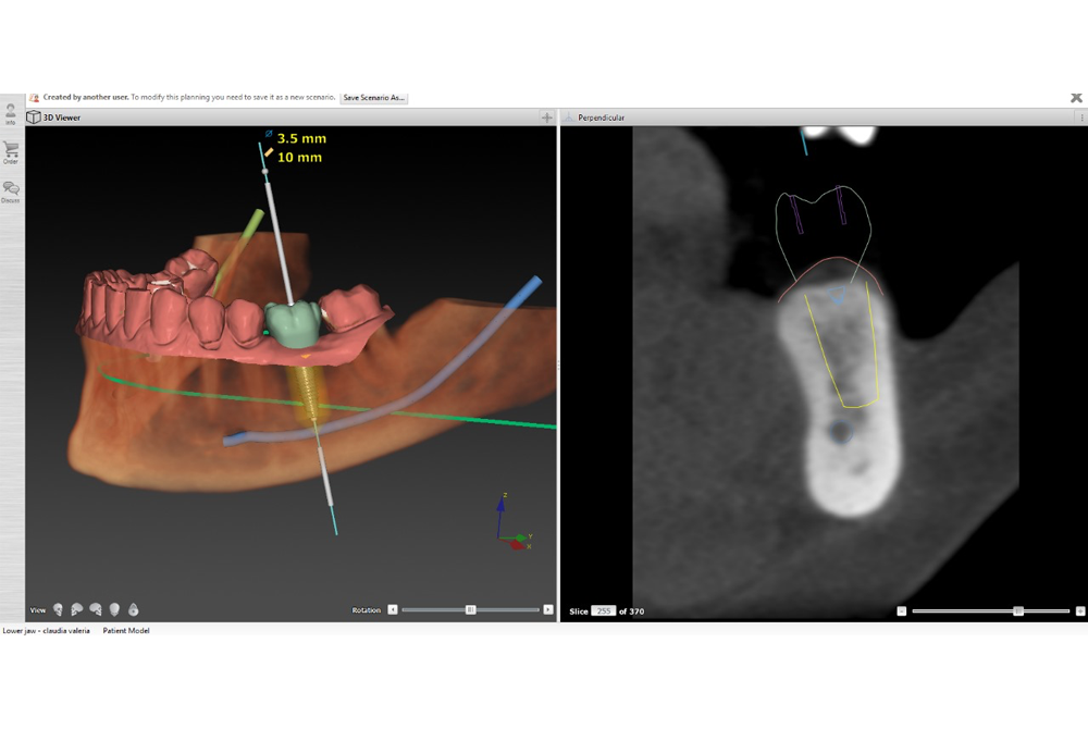 Cirurgia guiada e perda óssea zero - Vasconcellos Concept